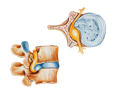 Link to: /pages/herniated-discs
